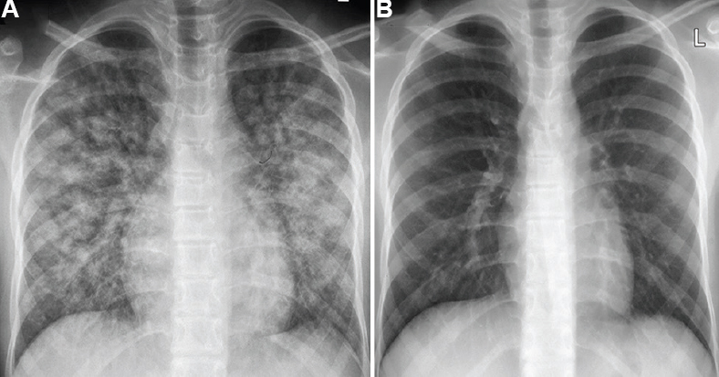 (A) Chest radiograph showing bilateral lung infiltrates consistent with acute respiratory distress syndrome. (B) A normal radiograph at a three-week follow up.